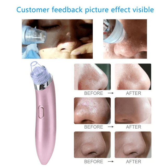 Aspirateur Électrique Anti-Points Noirs – Nettoyeur de Pores Visage et aspirateur de graisses 2